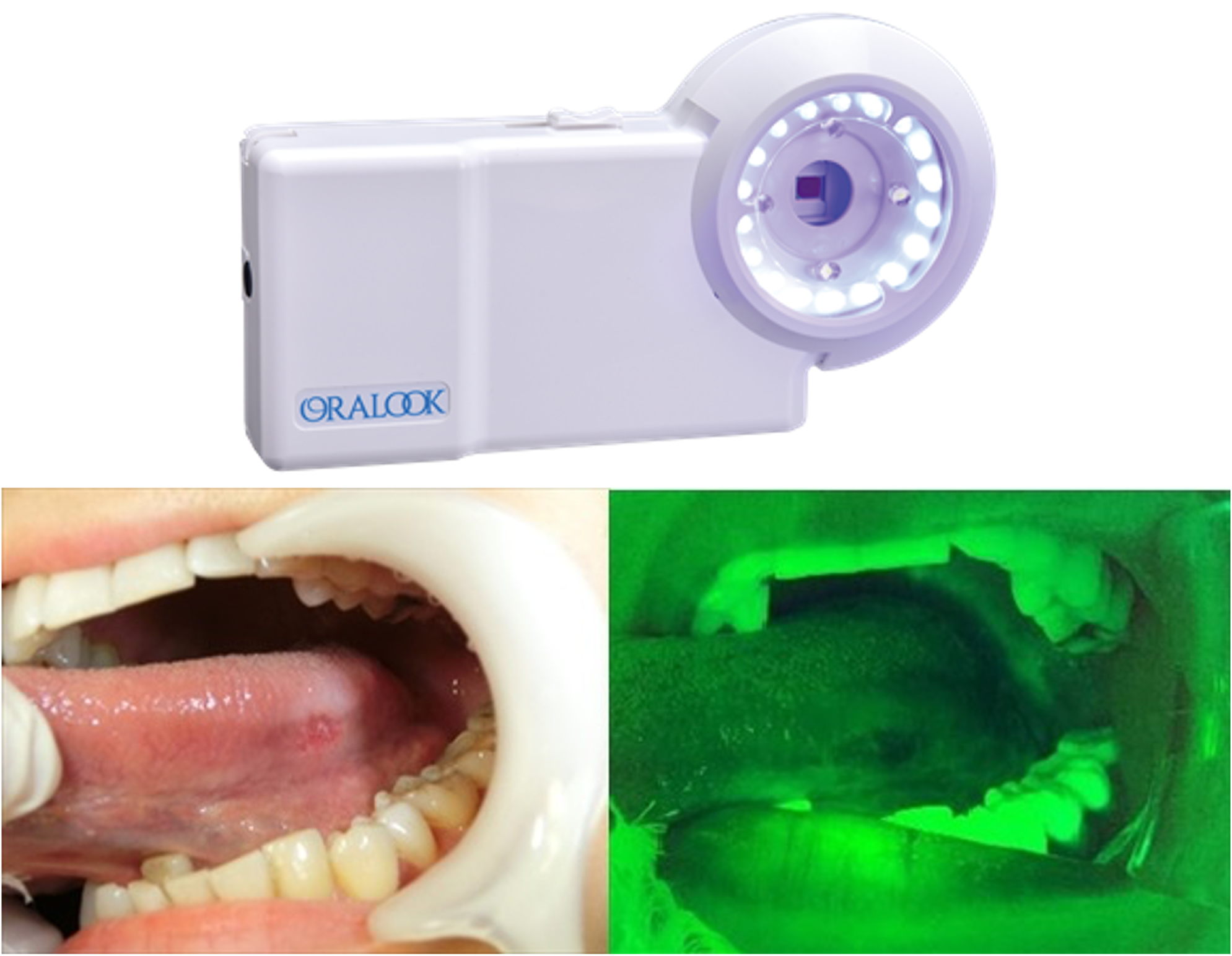 口腔内蛍光観察装置（オーラルック）